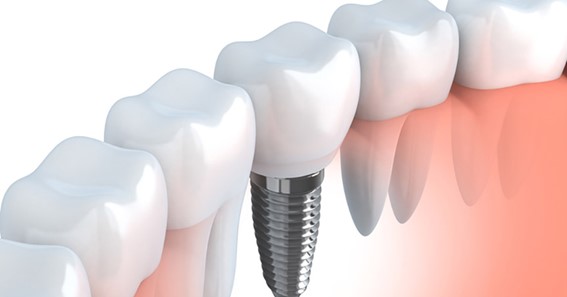 Common Dental Implant Problems You Should Know
