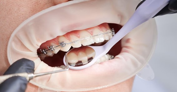 Explore the Latest Orthodontic Options for Adults